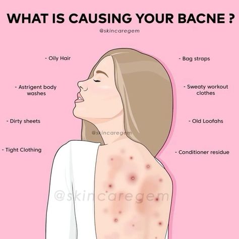 Struggling with back acne? Here are the possible causes