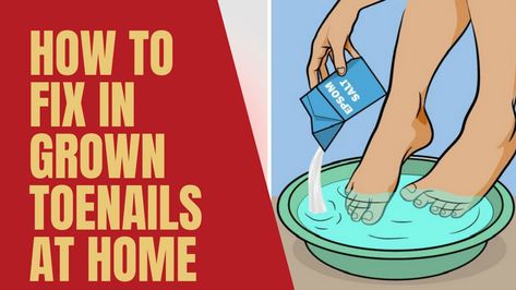 9 Effective Ways To Fix Ingrown Toenails At Home | Health - Fitness Natural Remedies For Migraines, Ingrown Toenail, Dry Skin Remedies, February Nails, Home Remedies For Hair, Home Health Remedies, Ingrown Toe Nail, Cold Home Remedies, Women's Fitness Motivation