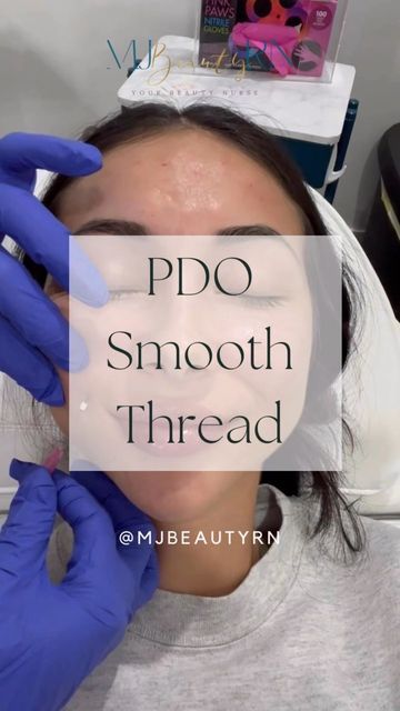 Mylene • Nurse | Artist | Injector on Instagram: "PDO Smooth threads✨ The process is easy and non-surgical. That’s why all of my clients loved it! Do you wonder if it’s painful? The answer is “No” it’s just a small pinch and no further sensations after the procedure. Want to have a NEW and beautiful smile this coming 2023? Book your appointment with me. 📩" Pdo Threads, Thread Lift, Book Your Appointment, Beautiful Smile, The Process, Black Women, Thread, Wonder, Instagram