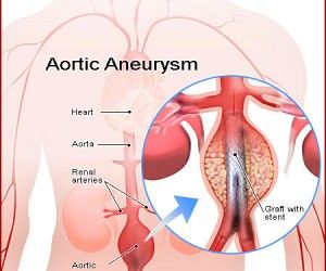 Abdominal Aorta, Brain Surgeon, Vascular Surgery, Types Of Surgery, Circulatory System, Cardiovascular System, Medical Knowledge, Anatomy And Physiology, The Human Body