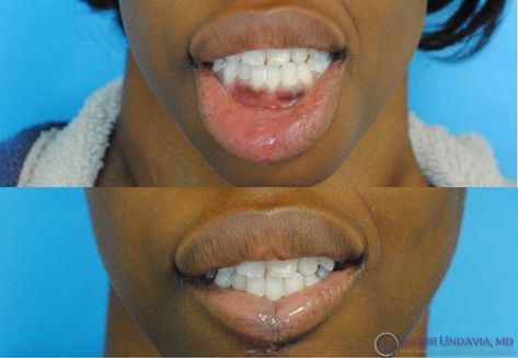 This is a 3 week before and after lip reduction result for a patient with congenital progressive lower lip laxity. Lip Reduction Before After, Lip Reduction, Scar Revision, Lower Lip, Plastic Surgery, Surgery, Lips