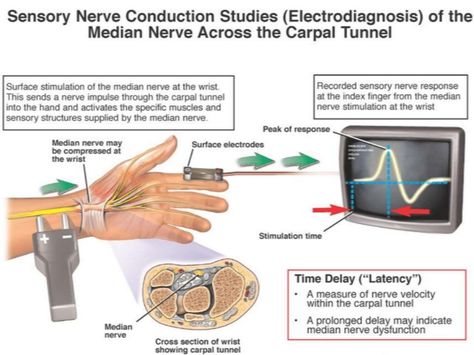 Trigger Points Neck, Wrist Injuries, Neurology Nursing, Nerve Conduction Study, Ulnar Nerve, Sensory Nerves, Median Nerve, Brain Mapping, Wrist Injury