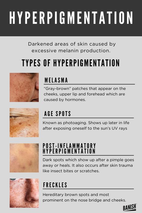 Best For Hyperpigmentation, Types Of Hyperpigmentation, Skin Education, Get Rid Of Hyperpigmentation, Remove Skin Tags Naturally, Forehead Acne, Post Inflammatory Hyperpigmentation, Skin Facts, Treating Hyperpigmentation