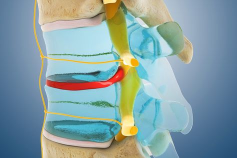 Common Spine Problems Explained With Pictures | WebMD Spine Problems, Vertebral Column, Spine Pain, Good Diet, Professional Massage, Sciatic Nerve, Better Posture, Poor Posture, Senior Fitness