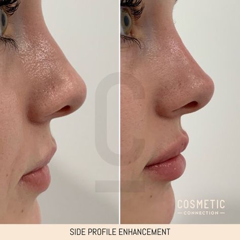 Rhinoplasty Side Profile, Lip Filler Before And After Side Profile, Profile Balancing Fillers, Lip Fillers Side Profile, Nose Tip Filler, Best Nose Shape, Lip Filler Side Profile, High Nose Bridge Side Profile, Subtle Nose Job