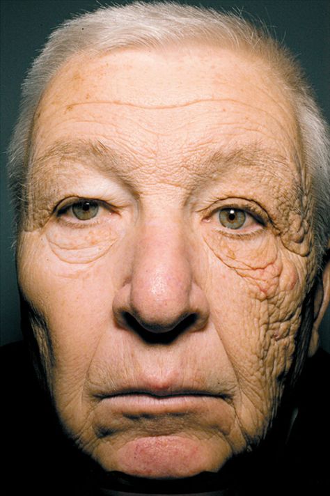 Sun Damage After 28 Years Of Driving A Delivery Truck Sun Damaged Skin, Face Wrinkles, Sun Care, Presents For Men, Wear Sunscreen, Diy Skin Care, Diy Skin, Look Younger, Truck Driver