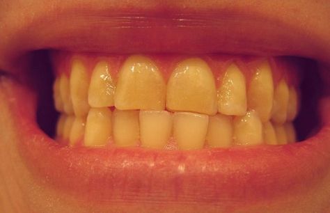 5 Ways to Get Rid of Yellow Teeth | HubPages Make Teeth Whiter, Coffee Stain Removal, Plaque Teeth, Homemade Mouthwash, Teeth Whitening Remedies, Yellow Teeth, Dental Veneers, Acidic Foods, Grinding Teeth