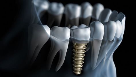 Dental Implant Procedure, Best Dental Implants, Dental Implant Surgery, Dental Implants Cost, Oral Surgeon, Restorative Dentistry, Implant Dentistry, Emergency Dentist, Teeth Implants