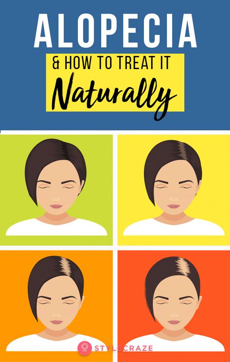 Grow thicker & fuller hair with THIS (all-natural) Shampoo For Alopecia, How To Treat Alopecia, Natural Remedies For Alopecia, Extreme Hair Fall Remedies, Traction Alopecia Regrowth, Alopecia Natural Remedies, Alopecia Hairstyles, Hair Falling, Traction Alopecia