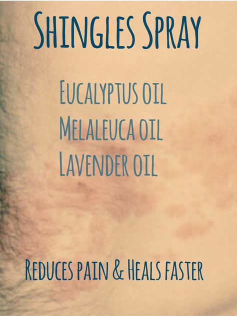 Essential Oils For Shingles, Essential Oils For Pain, Essential Oil Diffuser Blends Recipes, Essential Oil Remedy, Oil Remedies, Essential Oils Herbs, Essential Oils Health, Essential Oil Blends Recipes, Essential Oil Mixes