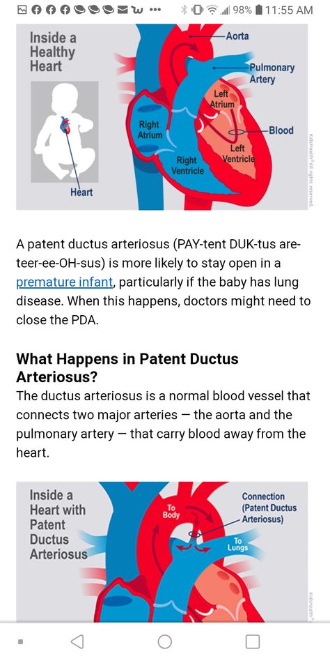 Patent Ductus Arteriosus, Circulatory System, Nclex, Blood Vessels, Heart Healthy, Disease, Medical