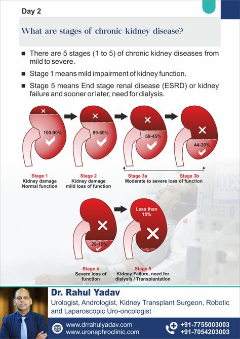 "Kidney Connect Series: Your Daily Guide to Kidney Health!" Day 2: What are stages of chronic kidney disease?" Welcome to "Day 2" of our series!  Follow daily for kidney health insights.  Learn, share, & help others on the journey to better health.  #CKD #ESRD #Dialysis #RenalFailure #KidneyTransplant Kidney Damage, Chronic Kidney, Kidney Health, Health Day, Better Health, Help Others, To Day, Helping Others, Disease