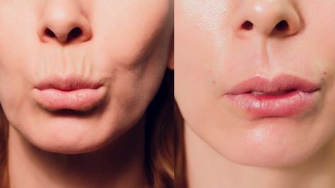 Benefits Of Lip Filler, Lip Threading Before And After, Threading Upper Lip, Pdo Thread Lift Before And After, Lip Threading, Pdo Thread Lift Before And After Face, Thread Lift, Semi Permanent Makeup, Lip Enhancement