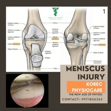 Meniscus Injury:-Menisci transmit approximately 50% of weight- bearing forces across the knee joint in extension and 85% at 90Â° of knee flexion.In the medial compartment, the medial meniscus bears 50% of the load; whereas in the lateral compartment, the lateral meniscus carries approximately 70% of the load transmitted across the lateral compartment. Removal of the medial meniscus results in 50 to 70% reduction in femoral condyle contact area and In a 100% increase in contact stress. The menis Medial Meniscus, Meniscus Injury, Human Skeleton, New Age, The Knee, Skeleton, Bears, Human