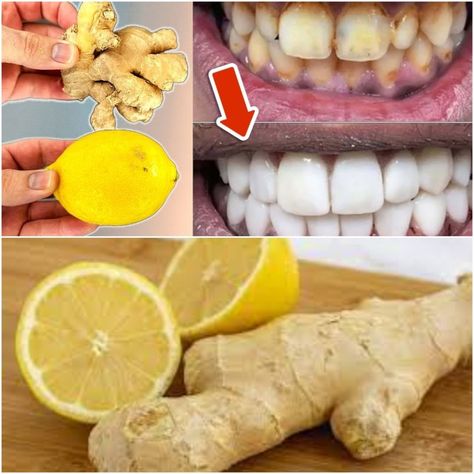 Brighten Your Smile with Simple Home Remedies Ginger And Lemon, Teeth Whitening Homemade, Potato Juice, Whiten Teeth, Infused Water Recipes, Yellow Teeth, The Teeth, Lemon Ginger, Natural Teeth Whitening