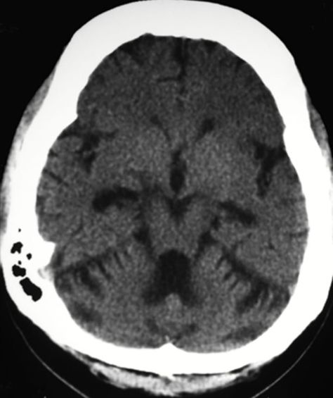 History of epilepsy, taking drugs since 15 years - phenytoin induced cerebellar atrophy & thickened calvarium. Eye Mask, Sleep Eye Mask, Brain, Mask, History