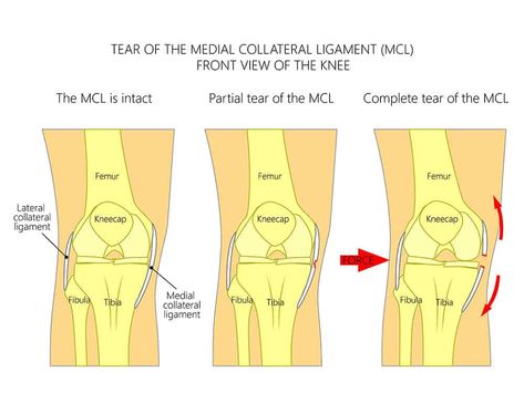 MCL Sprain Recovery Time - Injury Health Blog Knee Sprain Recovery, Medial Knee Pain, Mcl Injury, Acl Recovery, Meniscal Tear, Knee Ligaments, Acl Surgery, Knee Strengthening Exercises, Knee Pain Exercises