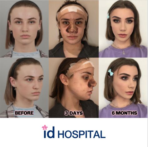 Transgender facial feminization before / after surgery in ID Hospital. Click to read her full story ❤️ #idhospital #ffs #facialfeminization #transgender #transgendersurgery #maletofemale #facialfeminizationsurgery #beforeafter #transmodel #cluamsutherland #transformation #idhospitalkoreabeforeafter Cosmetic Surgery Before And After, Ffs Surgery Before And After, Ffs Surgery, Before After Surgery, Nose Jobs, Rhinoplasty Nose Jobs, Plastic Surgery Photos, Broken Nose, Transgender Mtf