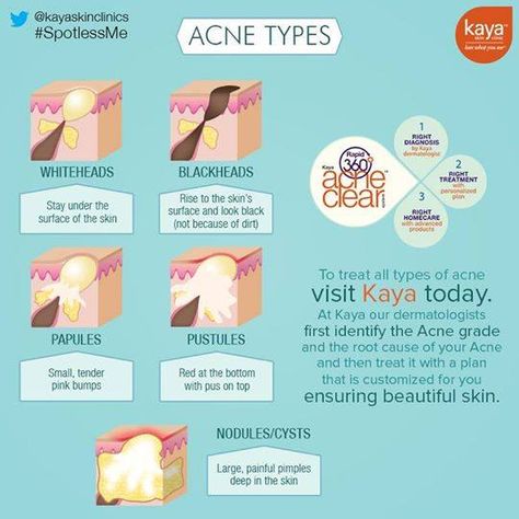 There are types of mild acne like whiteheads, blackhead & papules and severe acne types like pustules, nodules or cysts. Nodule Acne, Acne Types, Whiteheads Remedy, Mild Acne, Natural Acne Remedies, Severe Acne, Types Of Acne, Acne Scar Removal, Acne Free