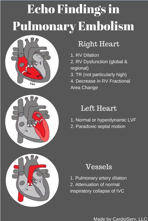 Learn how to recognize the signs of pulmonary embolism in echo. Review how findings like the McConnell's Sign and enlarged RV help with the diagnosis. Cath Lab Nursing, Diagnostic Medical Sonography Student, Medicine School, Cardiac Sonography, Cardiology Nursing, Sonography Student, Ultrasound Sonography, Diagnostic Medical Sonography, Ultrasound Technician