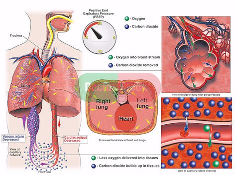 This medical exhibit describes the circulatory system impaired by a positive end expiratory pressure (PEEP) value over 15. The illustration consists of five images. The first image is a schematic diagram of the respiratory system and vascular network. The second image is a schematic of a PEEP reading. The third image is a transverse section through the thorax. The fourth image is a microscopic view of alveoli. The fifth image is a microscopic view of a blood vessel. Positive End Expiratory Pressure, Emt Study, Science Diy, What Is Nursing, The Circulatory System, The Respiratory System, Schematic Diagram, Cardiac Nursing, Becoming A Nurse