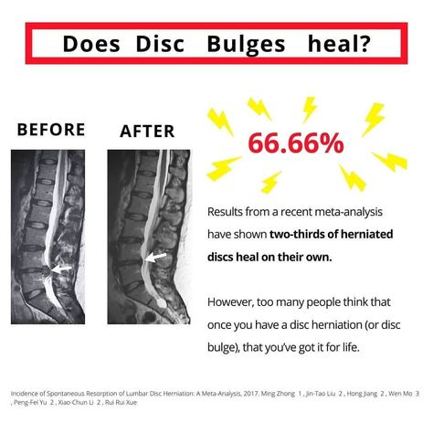 👋🏻 Here's a case report of a 28 year old with severe back and leg pain

📸 MRI November 2018 showed “Large L4/5disc protrusion w severe cord narrowing/ crowding of cauda equina rootlets”....

🕒 7 months later and a new round of imaging

📸 MRI May 2019 showed reabsorption and now pain free! 😱 Bulged Disc, Ruptured Lumbar Disc, Bulging Disc L5 S1, Pain Scale 1-10, Cervical Disc Degeneration, Cauda Equina, Lumbar Disc, Disk Herniation, Bulging Disc