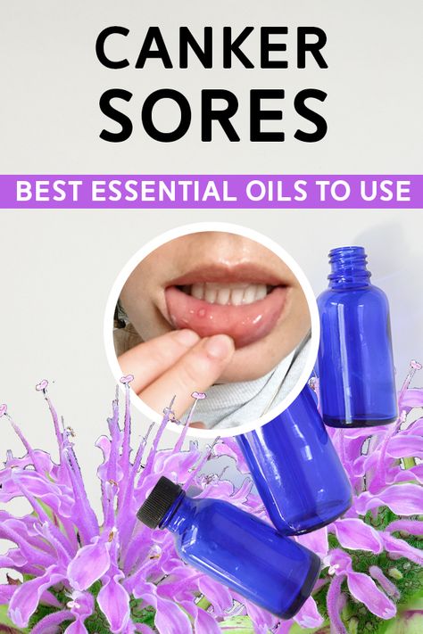 Essential Oils Canker Sore, Diy Mouthwash Recipes, Gum Pain Relief Remedies, Canker Sore Remedy, Diy Mouthwash, Home Gum, Cold Sore Relief, Chesty Cough, Essential Oils For Colds