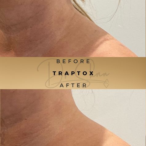 TrapTox Before & After Results at Dr Sknn Traptox Before And After, Feminine Shoulders, Botox Before And After, Anti Wrinkle Injections, Shoulder Tension, Anti Wrinkle Treatments, Aesthetic Medicine, Swan Neck, Posture Correction