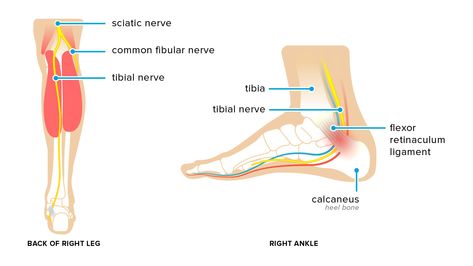 Tarsal Tunnel Syndrome: Symptoms, Causes, and Treatments Foot Pain Chart, Medical Consent Form Children, Tibial Nerve, Tarsal Tunnel, Nerve Conduction Study, Health Notes, Recondition Batteries, Pinched Nerve, Ankle Pain