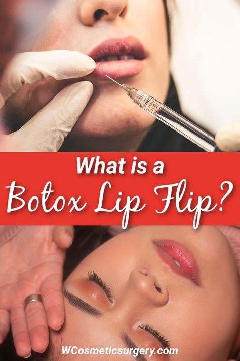 Botox lip flip procedures are gaining a lot of ground online thanks to social media, but it is important people understand lip flips. What Is A Lip Flip, Lip Flip Botox Injection Sites, Botox Under Eyes Before And After, Lip Flip Before And After, Lip Flip Botox Before And After, Botox Under Eyes, Botox Lip Flip, Diy Botox, Botox Injection Sites