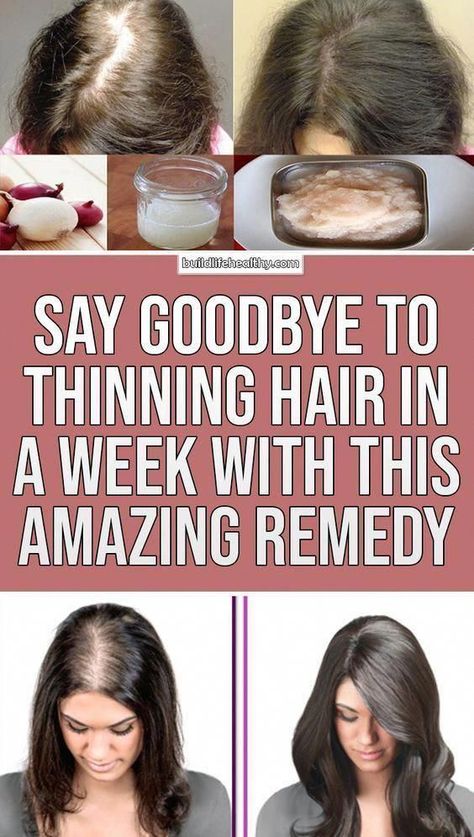 Say Goodbye to thinning Hair in week with this Amazing Remedy Hair Shedding Remedies, Postpartum Hair, Herbal Health, Health Essentials, Thick Hair Remedies, Get Thicker Hair, Castor Oil For Hair, Home Remedies For Hair, Hair Trim