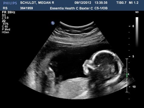 my baby boy!! Boy Ultrasound, Baby Ultrasound Pictures, Healthy Baby Boy, Pregnancy Ultrasound, Baby Ultrasound, Home Pregnancy Test, Ultrasound Pictures, Pregnancy Test, Night Aesthetic