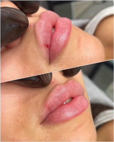 Different Styles Of Lip Filler, Madeline Cline Lip Filler, Heavy Upper Lip Filler, Sarah Cameron Lip Filler, Lip Filler For Uneven Lips, Key Hole Lip Filler, Lip Filler Heavy Upper Lip, Madelyn Cline Lip Fillers, Lip Filler Types