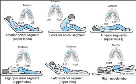 postural drainage positions Chest Physiotherapy, Postural Drainage, Lung Lobes, Massage Training, Therapy Exercises, Physical Therapy Exercises, Fundamentals Of Nursing, Chronic Obstructive Pulmonary Disease, Respiratory Therapy