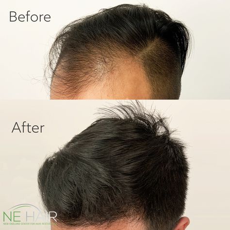 The Power of microFUE™️⁠⚡️    ⁠ #microfue #fuehairtransplant #hairtransformation #hairtransplantUSA #hairtransplantboston #hairline #hairsurgery #womensshairloss #thinninghair #hairlosssolution #hairrestoration #hairreplacement #selfcare #medspa #boston #fue #hairgrowth #eyebrowtransplant #hairtransplant #hairtransplantturkey #tediousjob #extractionsatisfaciton #extractionslovers #balding #nehair #hairloss #extractions #follicles⁠ #fueeurope #eyebrowrestoration Hair Surgery, Eyebrow Transplant, Paris Fashion Week Men, Fue Hair Transplant, Hair Replacement, Hair Restoration, Hair Transplant, Med Spa, Hair Transformation