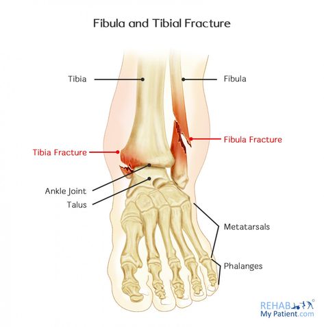 Fractured Ankle Recovery, Broken Ankle Recovery Tips, Ankle Fracture Recovery, Ankle Break, Broken Fibula, Fractured Ankle, Broken Ankle Recovery, Ankle Recovery, Ankle Workout