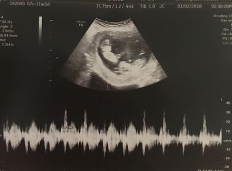 Saway twin heartbeats 11.5 weeks 5weeks Pregnant, Positive Pregnancy Test Pictures, Baby Ultrasound Pictures, Pregnant Life, Baby Ultrasound, Hospital Photography, Ultrasound Pictures, Positive Pregnancy Test, Queen Aesthetic