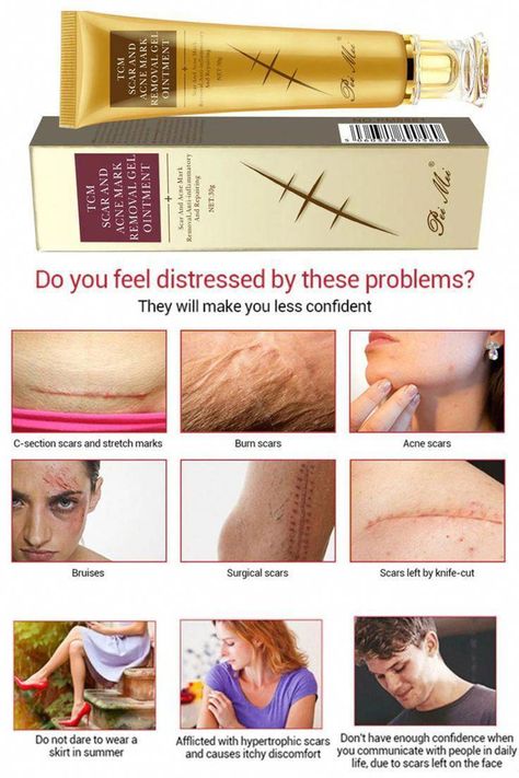 #NaturalHerbalRemedies #NaturalRemediesForSickness Remove Acne Marks On Face, Acne Mark Removal, Acne Scar Removal Cream, Coldsore Remedies Quick, Hypertrophic Scars, Hindi Comics, Scar Removal Cream, Losing 40 Pounds, Skin Natural Remedies