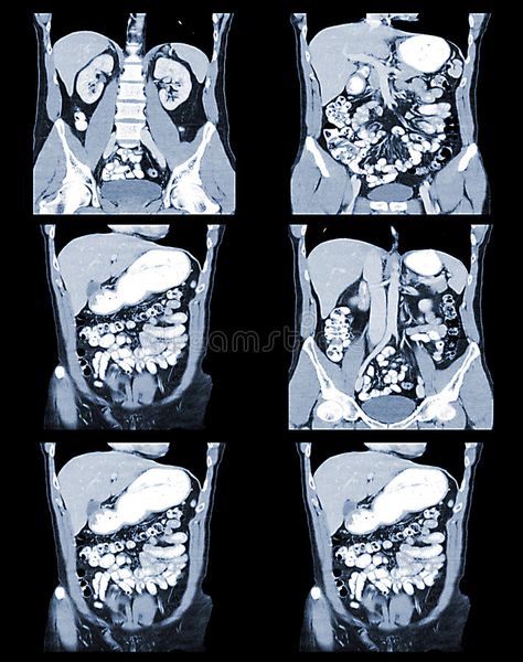 CT Abdomen. Sheet with multiple images of the abdomen CT scan #Sponsored , #paid, #Paid, #Abdomen, #abdomen, #scan, #Sheet Medical Radiography, Ct Scan, Design Infographic, Multiple Images, Human Design, Presentation Design, Infographic Design, Detailed Image, Presentation