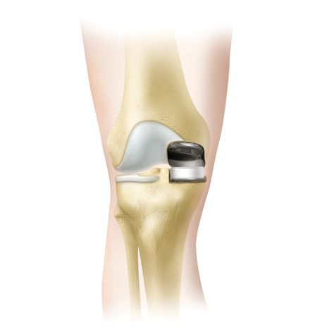 Medical Imaging Technology, Knee Replacement Recovery, Partial Knee Replacement, Knee Surgery Recovery, Cruciate Ligament, Knee Cap, Knee Replacement Surgery, Knee Exercises, Knee Surgery