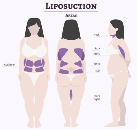 #LIPOSUCTION - #liposuctionrecovery - liposuction before and after - #bodycontouring Back Lipo Before And After, Lipo 360 Before And After, Loose Skin Surgery, Tummy Tucks Recovery, Lipo Before And After, Skin And Hair Clinic, Hair Clinic, Mommy Makeover, Facial Rejuvenation