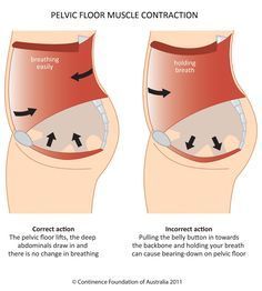 Diagram of correct and incorrect pelvic floor muscle contraction Diástase Abdominal, Pelvic Floor Muscle Exercise, Hip Problems, Pelvic Floor Dysfunction, Pelvic Floor Exercises, Kegel Exercise, Muscle Contraction, Pelvic Floor Muscles, Diastasis Recti