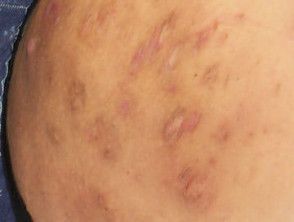 Acne Inversa, Systemic Inflammation, Fresh Tuna, Genetic Disorders, Nerve Damage, Skin To Skin, Inflammatory Foods, Processed Meat, Skin Disorders