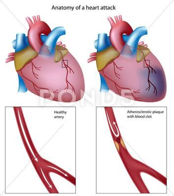 Heart attack Stock Illustration #AD ,#attack#Heart#Illustration#Stock What Is Cholesterol, Cholesterol Symptoms, Medical Intuitive, Cholesterol Remedies, Cholesterol Lowering Foods, Hdl Cholesterol, Healthy Cholesterol Levels, Heart Muscle, Medical Tests