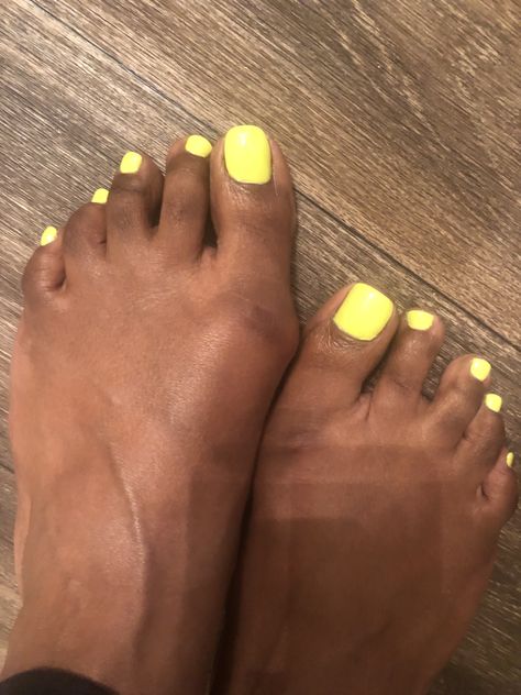 Ugly Feet Pedicure, Feet Pedicure, Fingernails Painted, Foot Pedicure, Pedicure Designs, Toenail Polish, Foot Care, Lemon Juice, Toe Nails