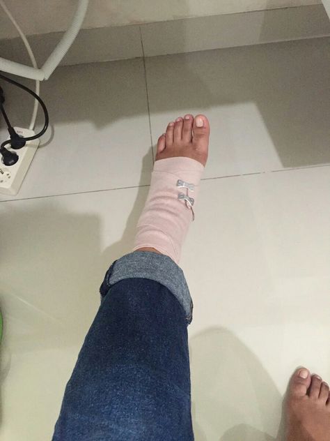 Ankle Injury Snapchat, Injured Leg Snap, Leg Fracture Snap, Sprained Ankle Snapchat, Leg Accident Real Pic, Knee Injury Snapchat, Injured Leg Snapchat, Leg Bandage Snapchat, Broke Leg Snapchat