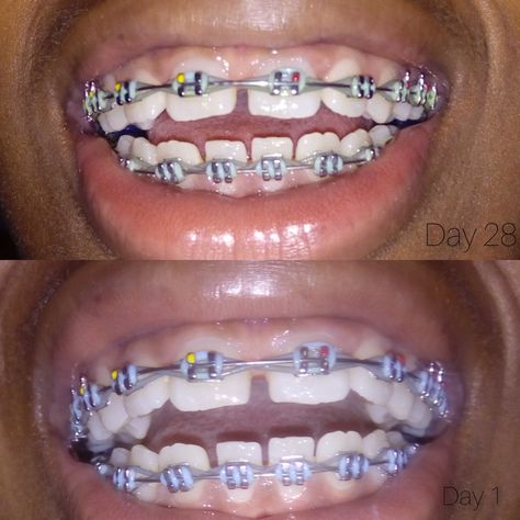 Gap tooth brace Braces With Gap Teeth, Gap Tooth, Gap Teeth, Teeth Braces, Really Funny Pictures, Braces, Gap, Funny Pictures, Funny