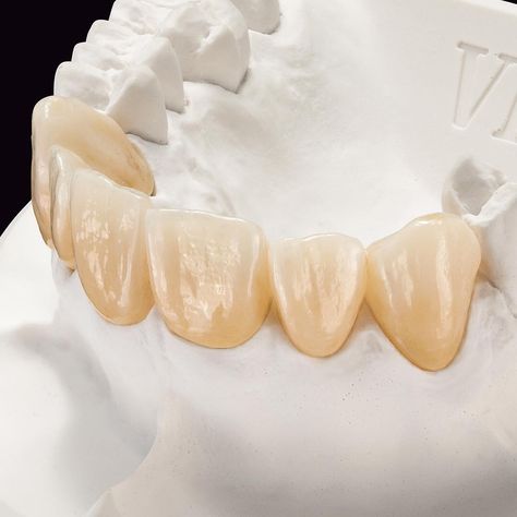 Dental Ceramics, Aesthetic Dental, Dental Aesthetics, Dental Anatomy, Dental Technician, False Teeth, Smile Please, Dental Life, Dental Veneers