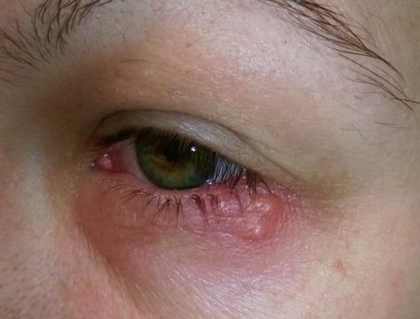 What does eye herpes look like? Eye Nerves, Fever Blister, Eye Infections, Light Sensitivity, Skin To Skin, Cold Sore, Itchy Skin, Pink Eyes, Dermatology