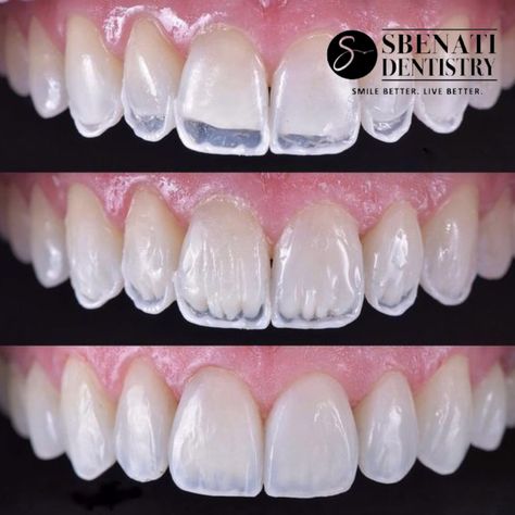 Pretty Teeth, Dental Videos, Veneers Teeth, Dental Anatomy, Aesthetic Dentistry, Dental Fillings, Beautiful Teeth, Dental Laboratory, Perfect Teeth